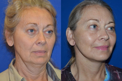 Woman in her 60s treated with Chin Surgery - Woman in her 60s treated with Chin Surgery using jowl implant as well as laser resurfacing to rejuvenate her look