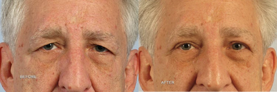 Male blepharoplasty - This male underwent upper blepharoplasty (eyelid lift) to improve hooding caused by excess eyelid skin. He maintains a masculine apperance but appears more alert and energetic.
