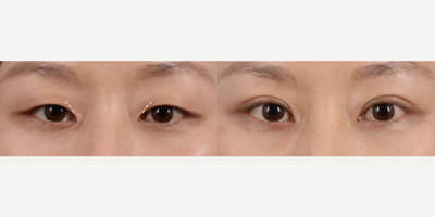 Woman treated with Eyelid Surgery - Woman treated with Eyelid Surgery