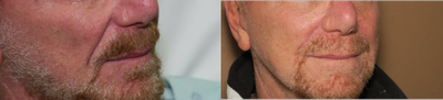 55-64 year old man treated with Facial - nasolabial fold excision
