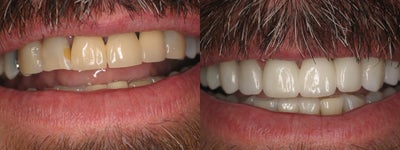 10 Porcelain Veneers -
Patient presented unhappy with discoloration and old crowns with metal margins. Was able to enhance his smile using the newest and greatest materials in dentistry. This patient is restored with ten empress veneers.