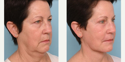 Woman treated with Facelift - Woman treated with Facelift