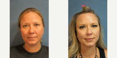 35-44 year old woman treated with RHA Collection Fillers - Restylane Defyne (nasolabial folds), RHA 2 (lips) and Voluma (2) (cheeks), Botox