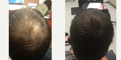 35-44 year old woman treated with ARTAS Robotic Hair Transplant - Pt transplanted 600 grafts in the crown. Pt also started propecia at the time of procedure.