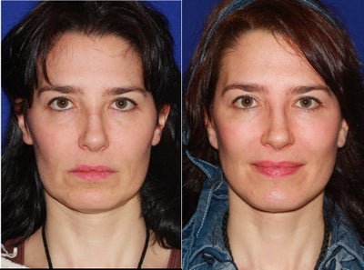 35-44 year old woman treated with Mini Facelift - This patient presented for a mini facelift. She was concerned with early aging changes including the jowls and some loose skin under the chin. Early aging changes were reversed with her rejuvenation procedure.