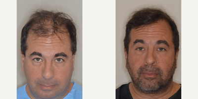 45-54 year old man treated with Hair Transplant - Male patient 1 year after 1302 FUE grafts to the frontal forelock. This treatment stresses the importance of the placement of grafts in the frontal forelock as a means of framing the face and providing a fuller appearance to the hairline. Initial treatments in cases of advanced baldness should focus on the frontal area of the scalp and not distribute the grafts throughout the scalp as a means of providing natural results and density to the hairline.