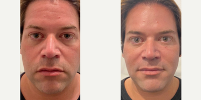 45-54 year old man treated with Nonsurgical Facelift - Liquid facelift result! This amazing patient came in and wanted to look more refreshed. Dr. Truesdale used an expert combination of Botox and fillers to achieve facial balance, reduction in wrinkles, and improve the patient's overall youthful appearance.