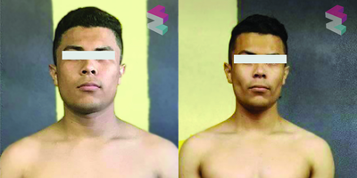 18-24 year old man treated with Buccal Fat Removal - Buccal fat pad removal on male patient.