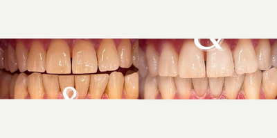 Patient treated with Smile Makeover, Teeth Whitening - We did dental cleaning and then sessions of whitening with our Zoom machine to improve results!