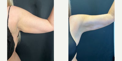 45-54 year old woman treated with Liposuction, Skin Tightening, Diastasis Recti Repair, BodyTite - The Patient presented for a tummy tuck with rectus plication, and liposuction and bodytite to the arms.