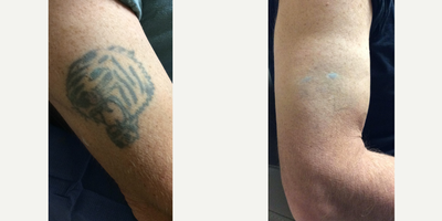 55-64 year old man treated with Tattoo Removal - Results after treatment with Enlighten 3 Laser. Jeffrey Gosin, M.D., FACS