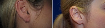 25-34 year old woman treated with Ear Lobe Surgery - Earlobe repair