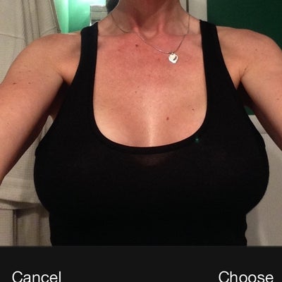 realself breast birmingham months implants augmentation al