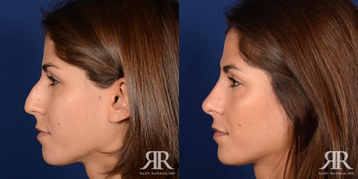 Rhinoplasty - Rhinoplasty