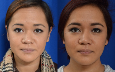 25-34 year old woman treated with Asian Rhinoplasty - Significant improvements to the bridge of the nose and width of the tip while maintaining ethnicity.