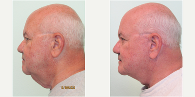 55-64 year old man treated with Neck Lift under Local Anesthesia - This older gentleman presented with the desire to lessen the heaviness and waddle under his chin. He had attempted a few different non-surgical options without significant result.Pre-op examination demonstrated severe laxity and fat deposition underneath his chin. Note that he did have a pre-exising vertical scar next to his left eye along with a pre-existing indentation above his ear from wearing eyeglasses.We decided together to perform a necklift and lower facelift under local anesthesia (with only mild oral sedation with valium) in the office. Procedure time was slightly over 2 hours time and all sutures were removed by the end of week #2. The majority of his swelling resolved by the end of week #2 as well.His results demonstrated marked improvement in his profile and overall heaviness of his lower face.