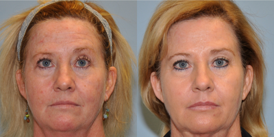 45-54 year old woman treated with Laser Resurfacing - This 52 year old was treated with BBL (broad band light) laser resurfacing.