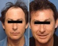 Man treated with Hair Transplant - Man treated with Hair Transplant