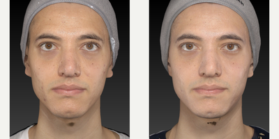 25-34 year old man treated with Microneedling, Skin Lightening, Skin Rejuvenation, Scar Removal - Microneedlin with our special device Nanopore Stylus 02This devices delivers a speed of 200 RPM and combined with a special cocktail of growth factors and liposomated BHA and AHAImpoves skin quality and overall texture, including scarsTotal of 4 sessions done on this patient Combined with a skincare regimen optimized for his needs