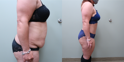 35-44 year old woman treated with Tummy Tuck - abdominoplasty (tummy tuck) with liposuction