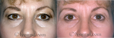 Upper and Lower Blepharoplasty - Facelift - 47-year-old woman before and after facial rejuvenation with upper and lower eyelid lift (blepharoplasty).