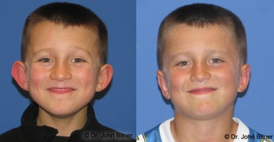 Otoplasty -
Otoplasty