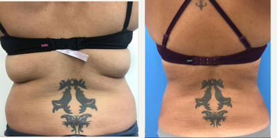 Woman treated with Liposuction, Smart Lipo, Laser Liposuction, Vaser Liposuction - Woman treated with Liposuction, Smart Lipo, Laser Liposuction, Vaser Liposuction
