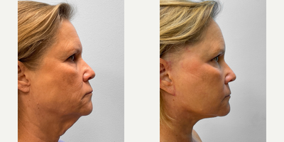 55-64 year old woman treated with Facelift, Brow Lift, Laser Resurfacing, Facial Fat Transfer - This woman in her early sixties wanted to enhance the overall appearance of her face and address fine lines, loose skin, and drooping eyelids. She and Dr. Howell discussed her options for facial rejuvenation of which she chose to proceed with a facelift, endoscopic browlift, TFX CO2 laser resurfacing and fat injections. Her results look natural with great symmetry and brow function. She is shown before and three months afterwards.