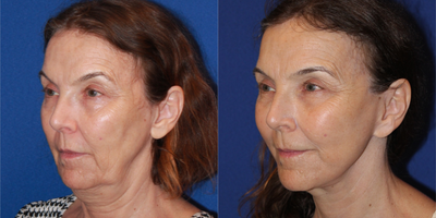 65-74 year old woman treated with Facelift & Necklift - 63 yo female who was not happy with how tired she appeared. She still works and is very energetic and did not feel her appearance matched with how she felt. Here she is one year after looking refreshed and rejuvenated. She underwent a face and neck lift without general anesthesia. Her neck and jawline look amazing , well contoured. Her neck appears longer and her incisions are barely visible.