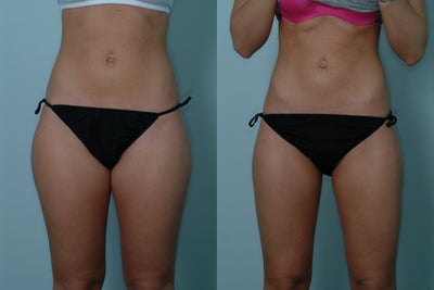 Smart Lipo -
A patient who has had SmartLipo.