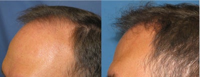 Hair Transplant -
Patient with male-pattern hair loss requested improvement. The photo is 5 months after a single large session hair transplant. 1850 follicular unit grafts were placed.