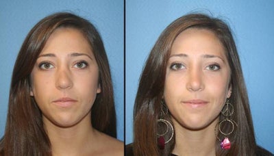 revision rhinoplasty -
Revision of nose to refine the nasal bone