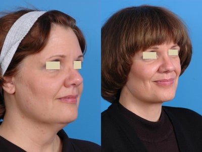 Facelift Results -
Necklift with sub-mental liposuction