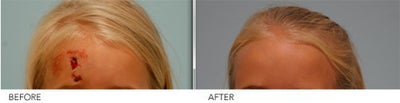 Laceration Repair - 
	Scar Removal , Repair of Laceration