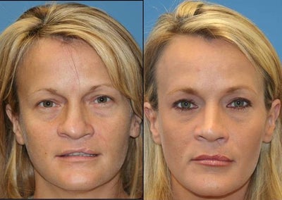 cleft palate rhinoplasty -
Revision Rhinoplasty