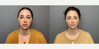 35-44 year old woman treated with Restylane, Dysport - Dysport on marionette, jaw line and under eyes filler.