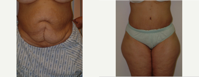45-54 year old woman treated with Tummy Tuck - Tummy Tuck Procedure