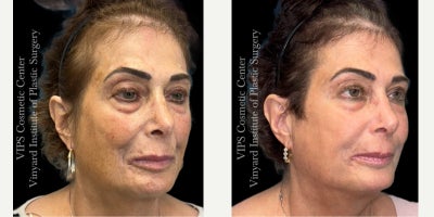 55-64 year old woman treated with CoolPeel, Skin Lightening, CO2 Laser, Skin Rejuvenation, IPL - This patient underwent a single-session combination treatment using CoolPeel laser resurfacing and the Elluminate Advanced Photofacial with IPL to address sun damage, hyperpigmentation, enlarged pores, and overall skin dullness.Her photos show brighter, more even-toned skin with softening of discoloration across the cheeks, temples, and lower face. Fine lines appear smoother, the complexion looks clearer and more refined, and the surface texture shows a noticeable boost in radiance and uniformity. By pairing fractional CO resurfacing with a multi-wavelength photofacial, this treatment targets both superficial and deeper pigment irregularities while stimulating collagen for long-term rejuvenation.This single combined session delivered a healthier, more refreshed complexion with improved clarity, reduced pigmentation, and a smoother overall appearancean excellent option for patients seeking visible skin renewal with little to no downtime.
