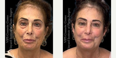 55-64 year old woman treated with CoolPeel, Skin Lightening, CO2 Laser, Skin Rejuvenation, IPL - This patient underwent a single-session combination treatment using CoolPeel laser resurfacing and the Elluminate Advanced Photofacial with IPL to address sun damage, hyperpigmentation, enlarged pores, and overall skin dullness.Her photos show brighter, more even-toned skin with softening of discoloration across the cheeks, temples, and lower face. Fine lines appear smoother, the complexion looks clearer and more refined, and the surface texture shows a noticeable boost in radiance and uniformity. By pairing fractional CO resurfacing with a multi-wavelength photofacial, this treatment targets both superficial and deeper pigment irregularities while stimulating collagen for long-term rejuvenation.This single combined session delivered a healthier, more refreshed complexion with improved clarity, reduced pigmentation, and a smoother overall appearancean excellent option for patients seeking visible skin renewal with little to no downtime.