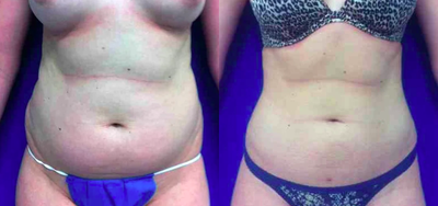 35-44 year old woman treated with Smart Lipo - smartlipo abdomen