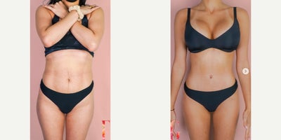 35-44 year old woman treated with Mommy Makeover, Breast Lift with Implants, Tummy Tuck - 35-44 year old woman treated with Mommy Makeover, Breast Lift with Implants, Tummy Tuck