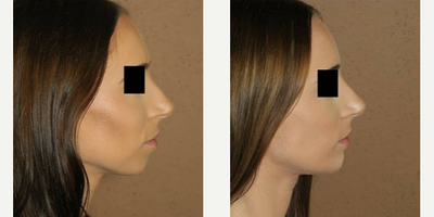 Woman treated with Chin Surgery - Woman treated with Chin Surgery