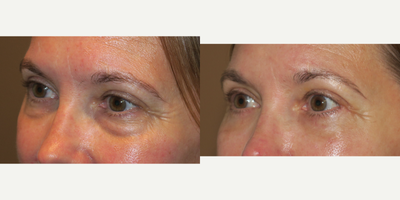 45-54 year old woman treated with Eyelid Surgery - Lower blepharoplasty