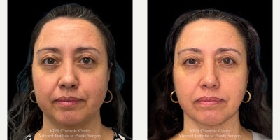 45-54 year old woman treated with CoolPeel, CO2 Laser - This 45-54 year old female patient underwent two CoolPeel CO Laser Skin Resurfacing treatments to improve overall skin texture and tone. Her results show smoother, more even skin with reduced fine lines and redness, revealing a refreshed and healthier-looking complexion with little to no downtime.