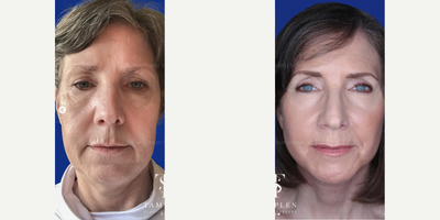 Woman treated with Deep Plane Facelift - Beautiful result just 3 months after deep plan #facelift and Co2 laser resurfacing.Her mid face has been treated, jowls are gone and neckline is beautiful! Elegant & natural results that we love.