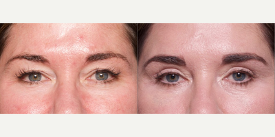 Woman treated with Brow Lift - Woman treated with Brow Lift