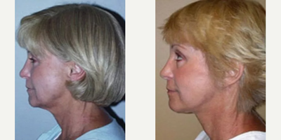 Woman treated with Brow Lift - Woman treated with Brow Lift