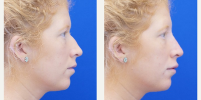 25-34 year old woman treated with Non Surgical Nose Job - Using Voluma the nasal bump and supratip depression is camouflaged by filling the void; this is a form of liquid rhinoplasty. Restylane Silk is also used to augment the upper lip. The result is evident on the same day of injection.