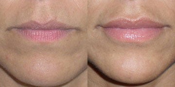 Lip Implants