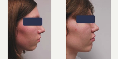 Woman treated with Chin Implant - This is a young lady who wanted more chin projection. We placed a silicone gel implant through a 2cm incision under the chin. This procedure only takes about 45 min and has a relatively easy recovery. She is now 4 months after her surgery and is very happy.